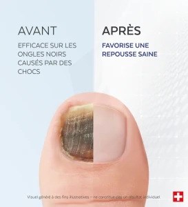 Poderm Fortifiant Huile-sérum Ongles Noirs Traumatisés Flacon De 8 Ml